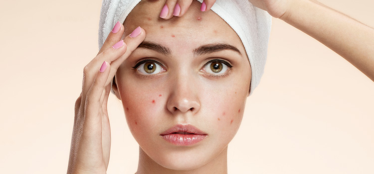 Trattamento acne Padova